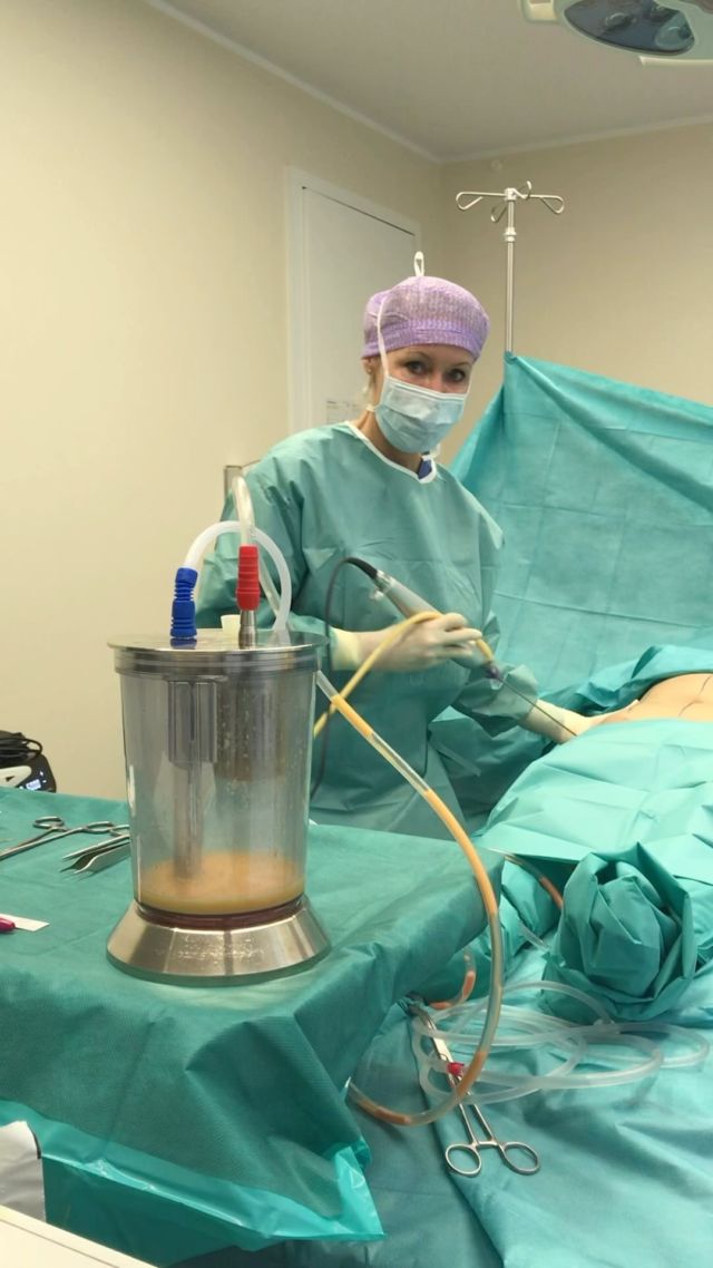 Liposuction is like playing the Violine, it’s about feeling the tissues and treating them gently #lipocuction #fattransferbreast #drjulianebodo #plastethics #plasticsurgery #femaleempowerment #bodycontouring