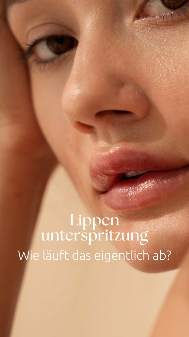 Du willst dir die Lippen aufspritzen lassen – aber weißt nicht, was dich erwartet?  👩🏼‍⚕️ Ich bin Dr. Juliane Bodo, plastische und ästhetische Chirurgin bei Plastethics in Berlin und erkläre dir ganz genau, wie die Behandlung abläuft und worauf du achten solltest. ☺️  Was dich erwartet:
🔹 Detaillierte Analyse & persönliche Beratung
🔹 Behandlung dauert ca. 20 Minuten – mit lokaler Betäubung
🔹 Leichte Schwellung ist normal & klingt nach ein paar Tagen ab
🔹 Das endgültige Ergebnis siehst du nach wenigen Tagen
🔹 Technik & Produktqualität machen den Unterschied
🔹 Auch die Nachsorge ist entscheidend für ein schönes, natürliches Ergebnis  👉🏻Du willst mehr über Ablauf & Pflege erfahren?
Dann buch dir gern einen Beratungstermin – Link in Bio.