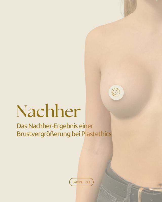 ✨ Nachher-Ergebnis mit 360 ml Premium Implantaten teilweise unter dem Muskel  Ein natürlicher Look mit harmonischer Form und schönem Volumen – genau so, wie es sich unsere Patientin gewünscht hat. 💫  Jeder Körper ist einzigartig – deshalb ist auch jede Behandlung individuell auf dich abgestimmt.  Du möchtest mehr über Implantatarten und Größen erfahren?
💬 Stell deine Fragen in den Kommentaren oder buche direkt einen Beratungstermin.