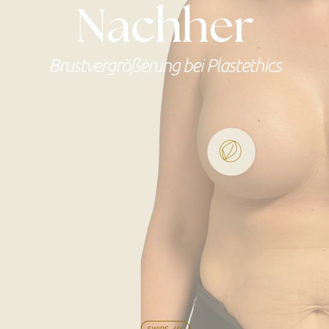 Das Ergebnis – Brustvergrößerung mit runden Implantaten  In diesem Fall wurden runde hochwertige Premium-Implantate teilweise unter dem Muskel eingesetzt: rechts 400 ml, links 380 ml. Das Ergebnis ist ein volleres, harmonisches Dekolleté mit natürlicher Form.  Vorteile runder Implantate:
✨Sorgt für mehr Fülle im oberen Brustbereich
✨Ideal für ein volles, feminines Dekolleté
✨Passen sich dem Brustverlauf auch bei Bewegung gut an  Jede Brust ist individuell – Gewebe, Form und gewünschtes Ergebnis sind immer unterschiedlich. Deshalb ist eine persönliche Beratung vor der Operation besonders wichtig.  👉🏻 Wenn du dich für eine Brustvergrößerung interessierst, buche dir gern einen Beratungstermin über den Link in unserer Bio, über die Website oder telefonisch.