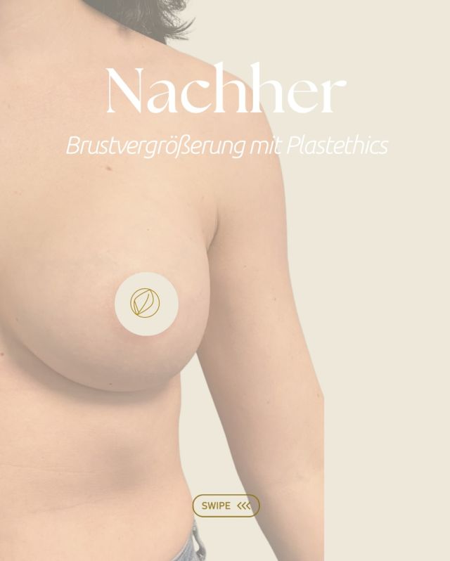 Diese Ergebnisse zeigen, wie natürlich eine Brustvergrößerung heute aussehen kann – auch mit Implantaten.  Die ausgewählten Premium Implantate sind mit einer weichen, fließenden Gelstruktur gefüllt, die auf die Schwerkraft reagiert:
👉🏻 Im Liegen entsteht eine runde, volle Form
👉🏻 Im Stehen zeigt sich eine natürliche, sanft abfallende Silhouette  In diesem Fall: 320 ml rechts, 360 ml links – dual plane, also teilweise unter dem Muskel - für ein harmonisches, symmetrisches Ergebnis, das perfekt zum Körper passt.  💬 Du möchtest wissen, welche Form und Größe zu dir passen könnten?
✨Buche gerne einen Beratungstermin über unsere Website.